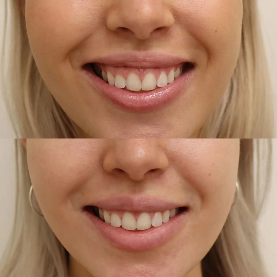 gummy-smile-eli-ienhymy-botox-helsinki-ebeling-kauneus