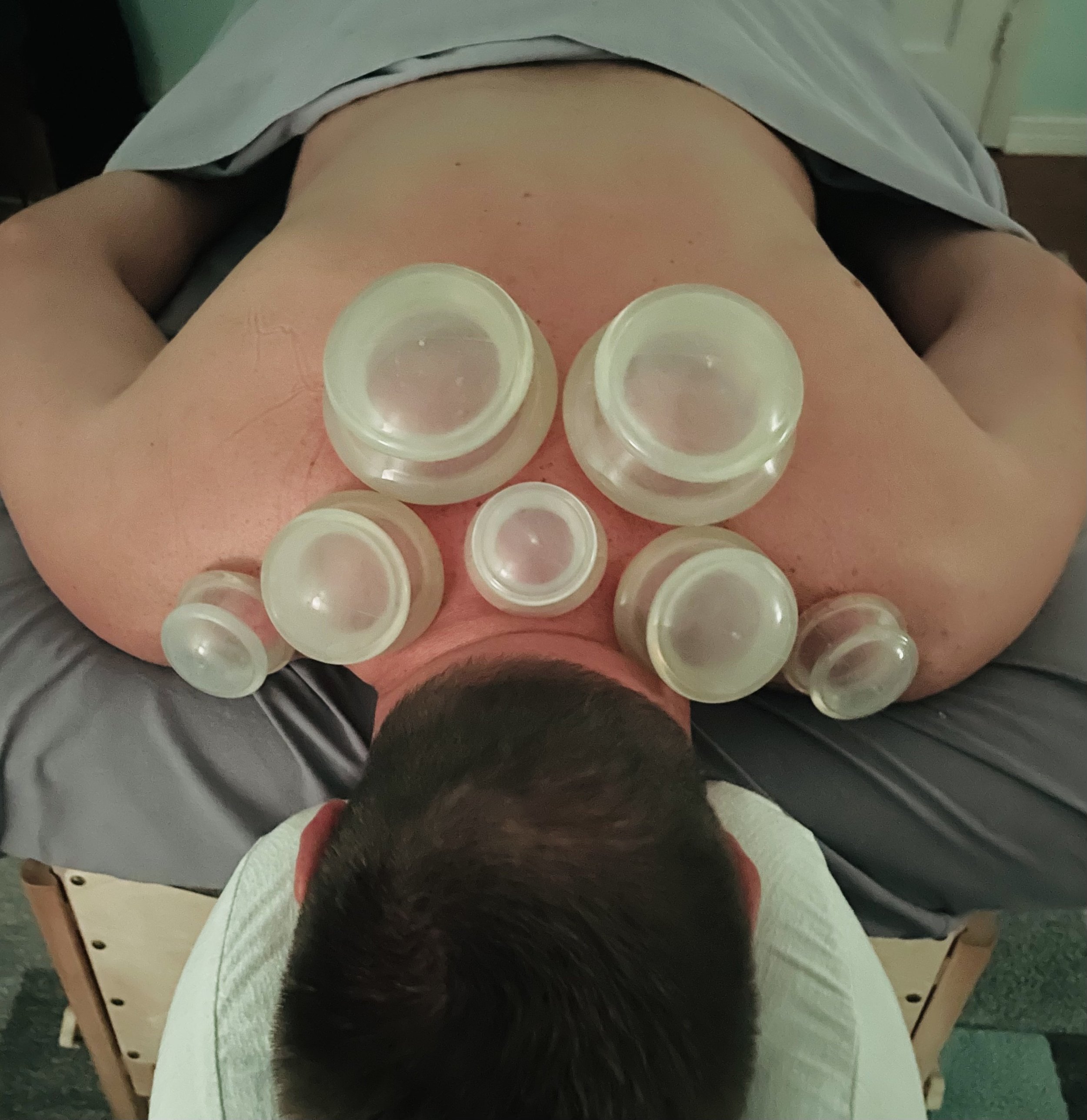 Unlocking the Benefits of Dynamic Cupping Therapy: A Unique Approach to Massage
