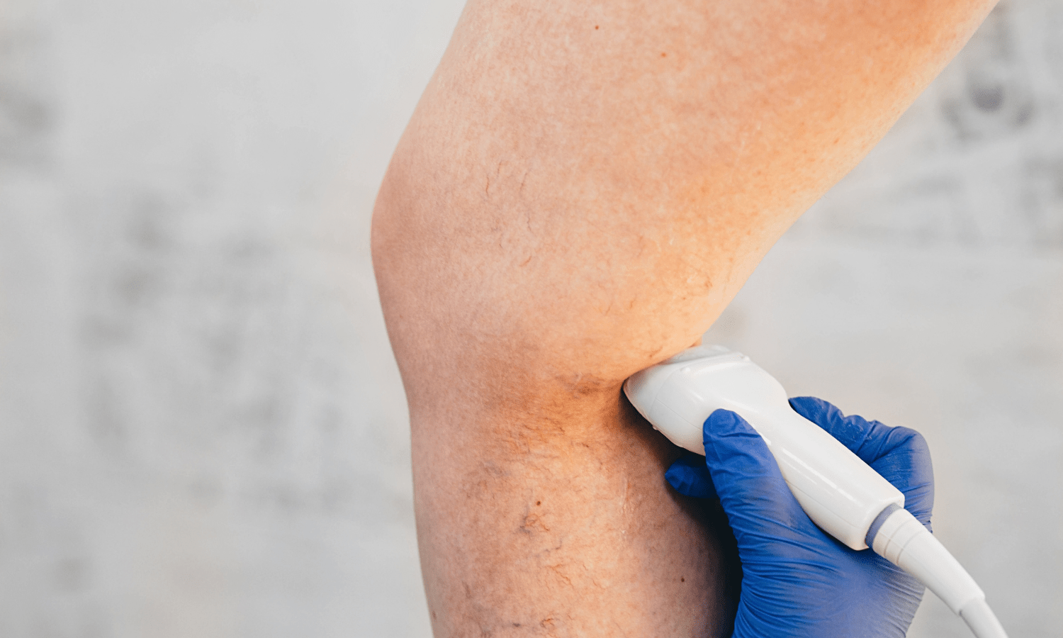 Top 5 Myths About Deep Vein Thrombosis