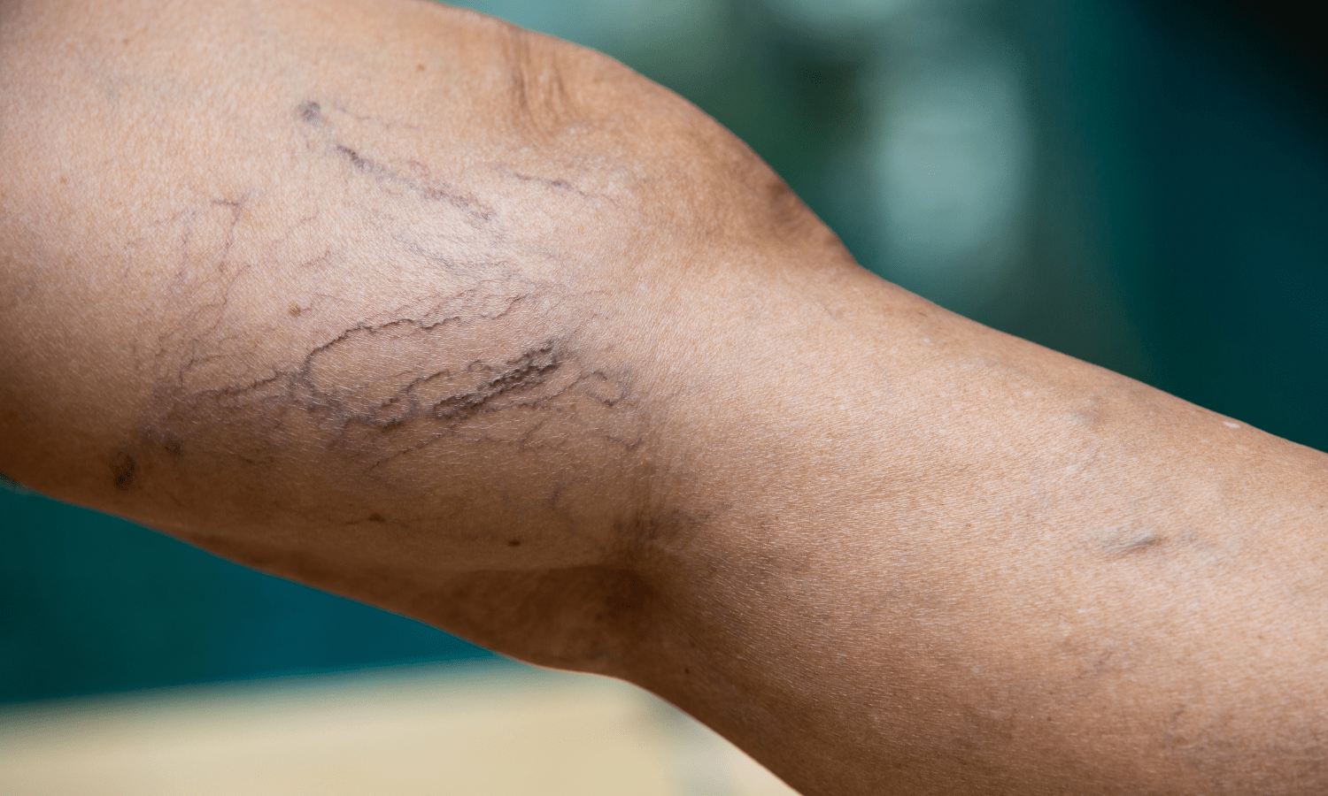 What Are The Common Misconceptions About Spider Veins?