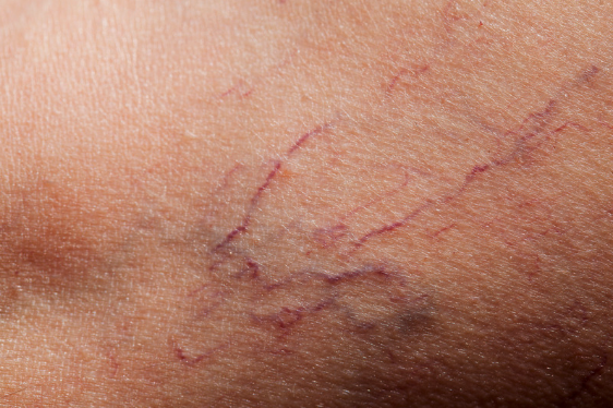 Spider Veins