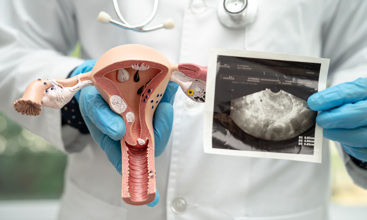 Can Fibroids Grow Back After Uterine Fibroid Embolization?