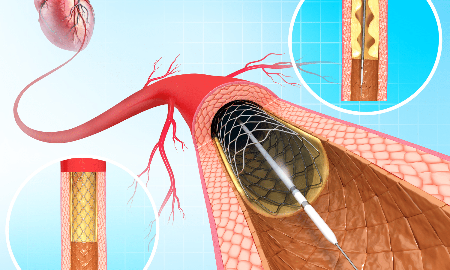 An image illustrating the benefits of angioplasty and stent placement using a heart, needle, and blood vessel.
