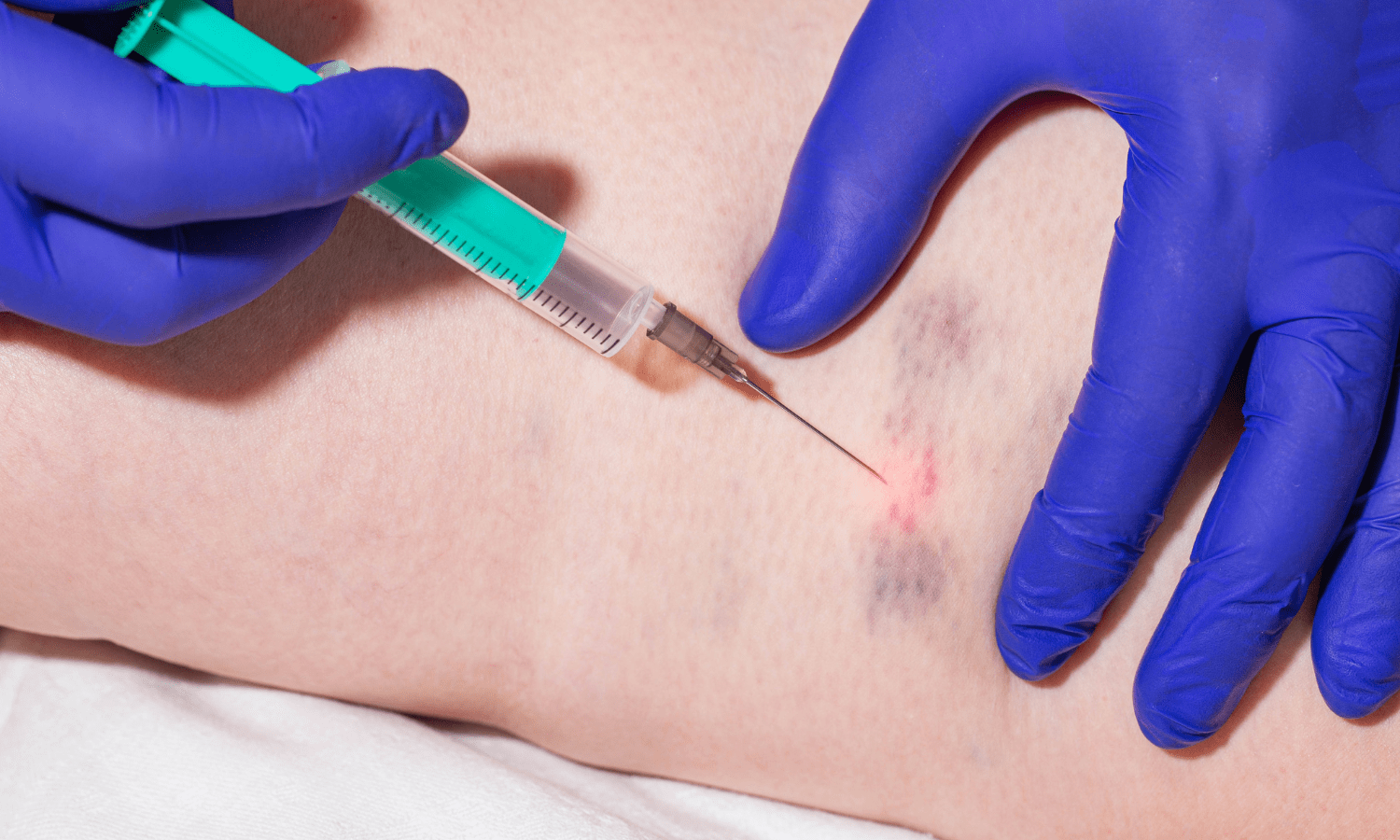 What To Expect After A Minimally Invasive Varicose Vein Treatment?