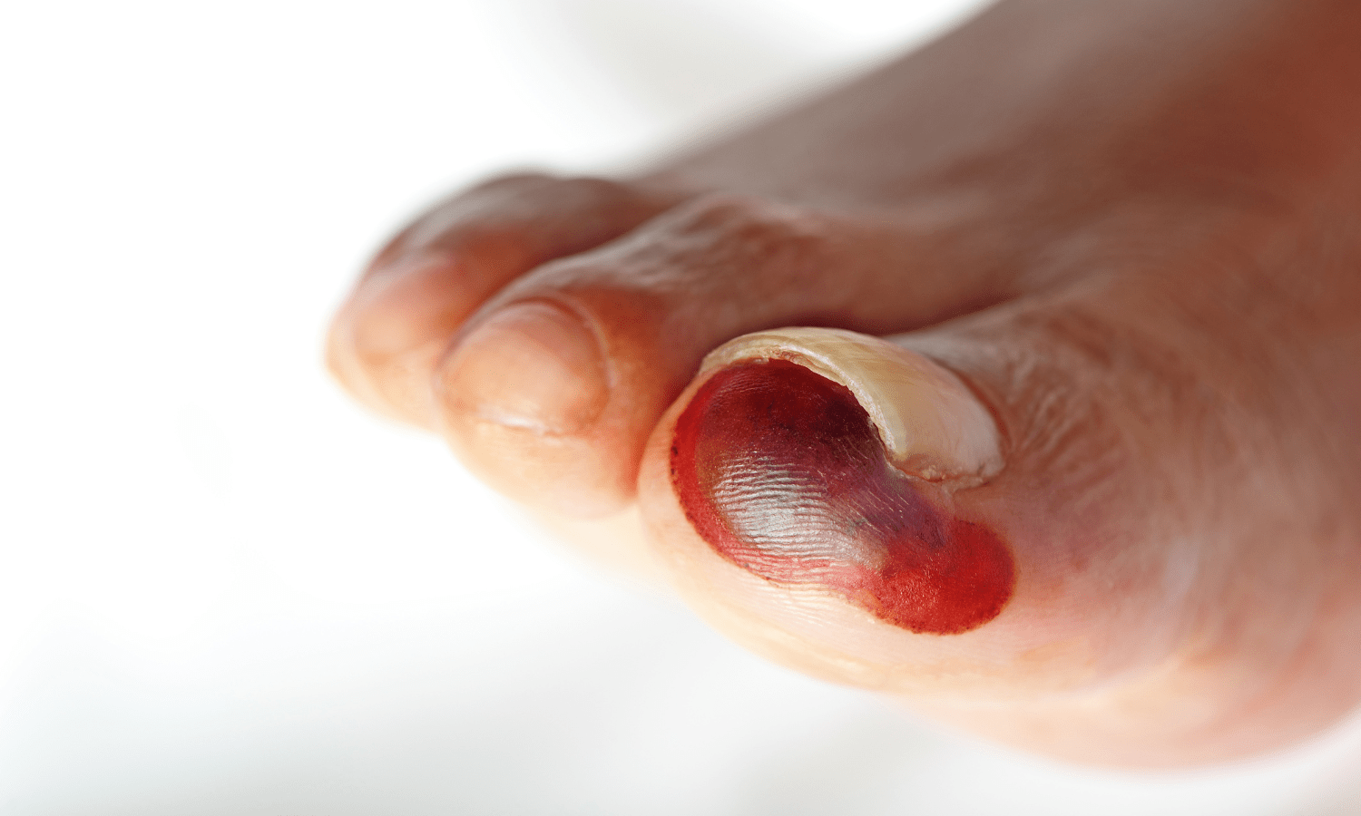 Critical Limb Ischemia