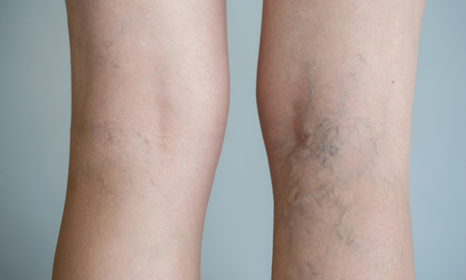 Benefits of Sclerotherapy for Varicose Veins: Improved appearance and symptoms in woman's legs.