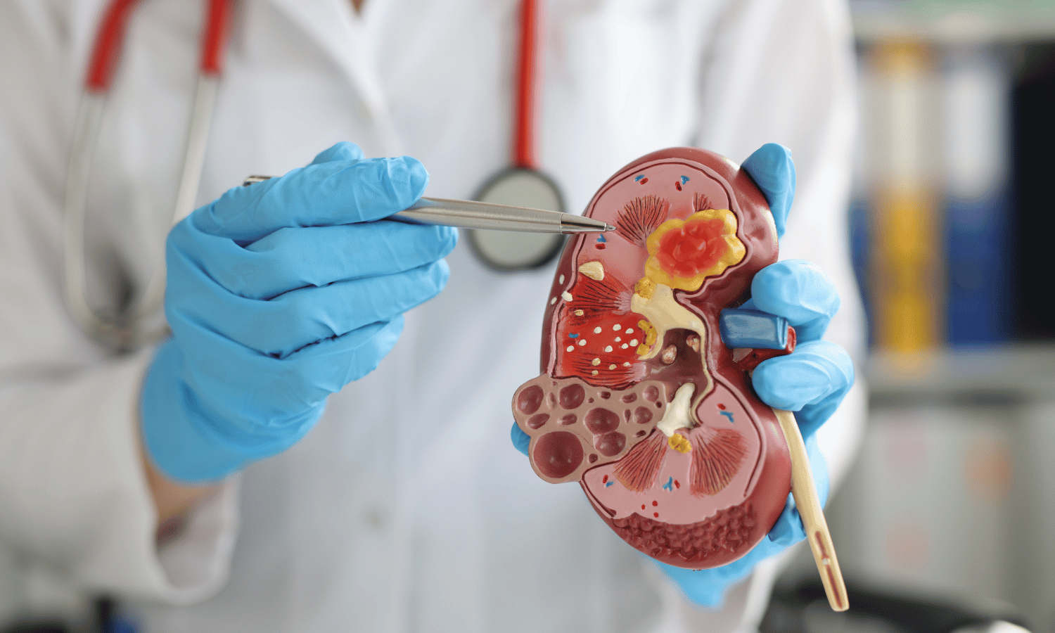What Are The Early Signs Of Chronic Kidney Disease?