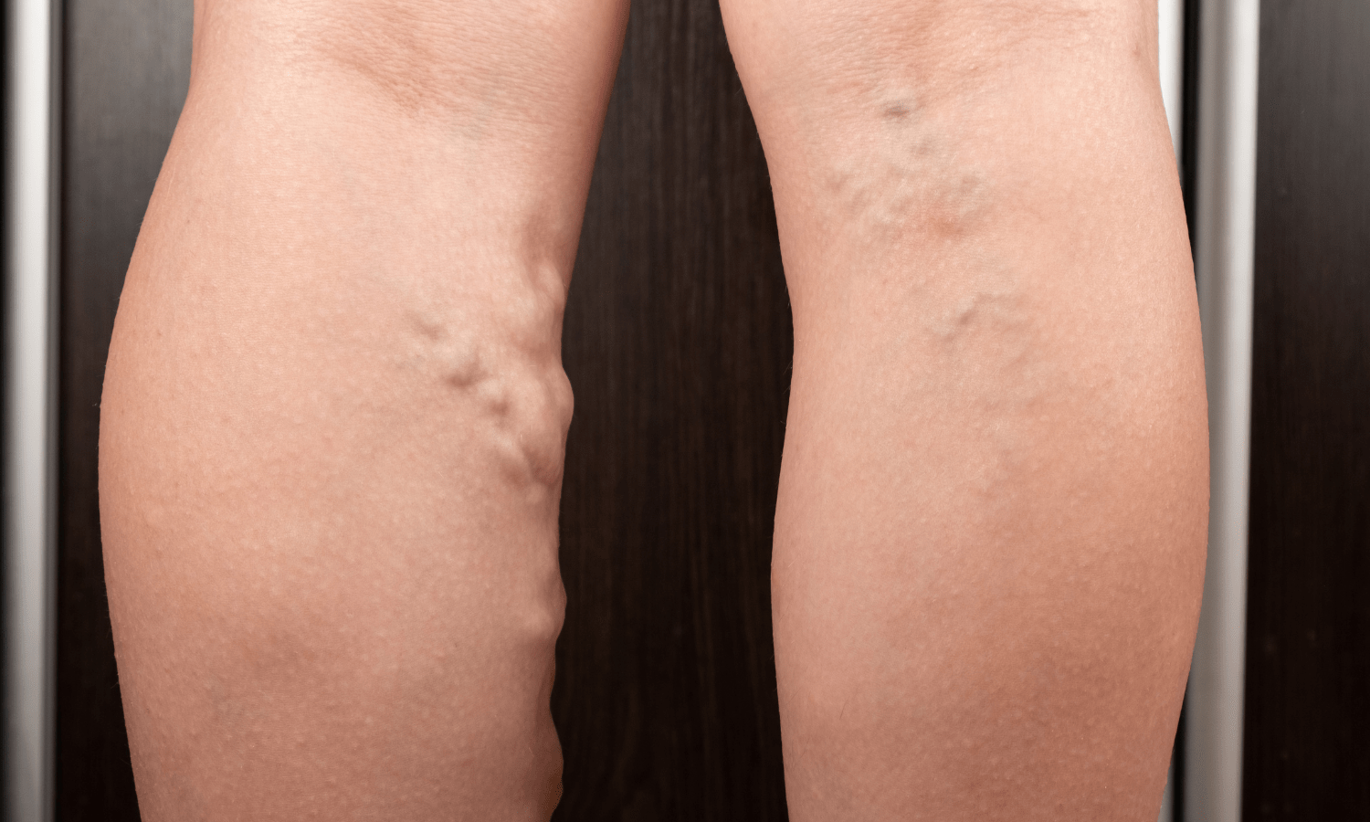 How To Treat Deep Vein Thrombosis?