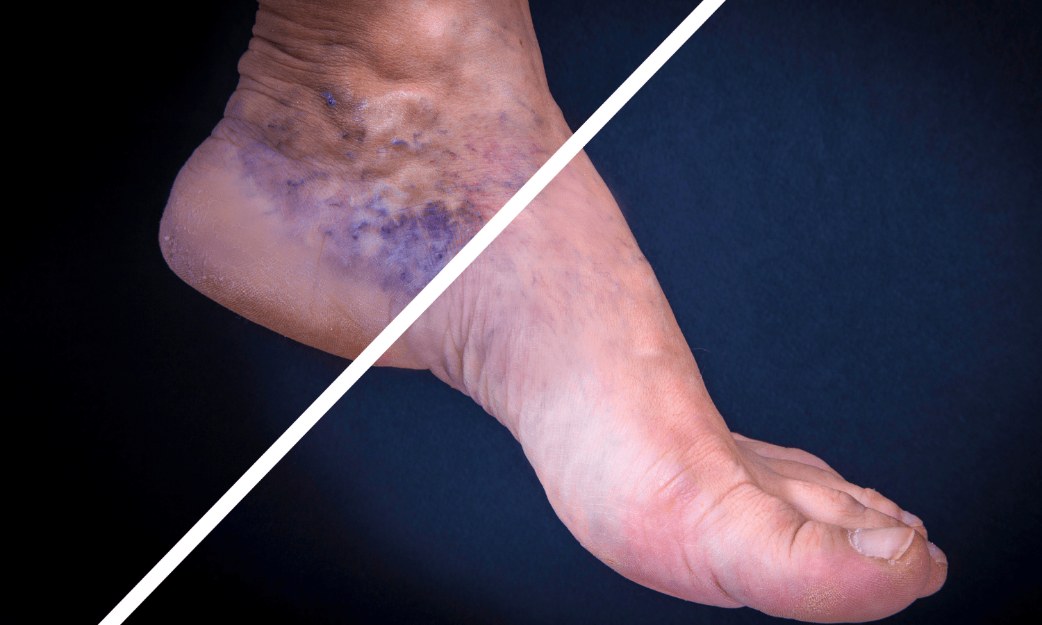 Impact of Heat and Cold on Varicose Veins — Indiana Vascular