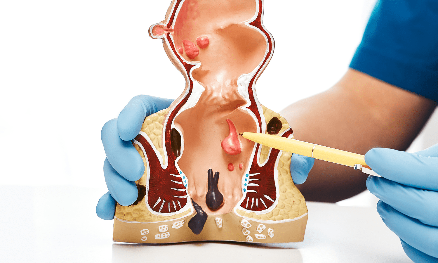 What Are The Benefits Of Hemorrhoid Embolization?