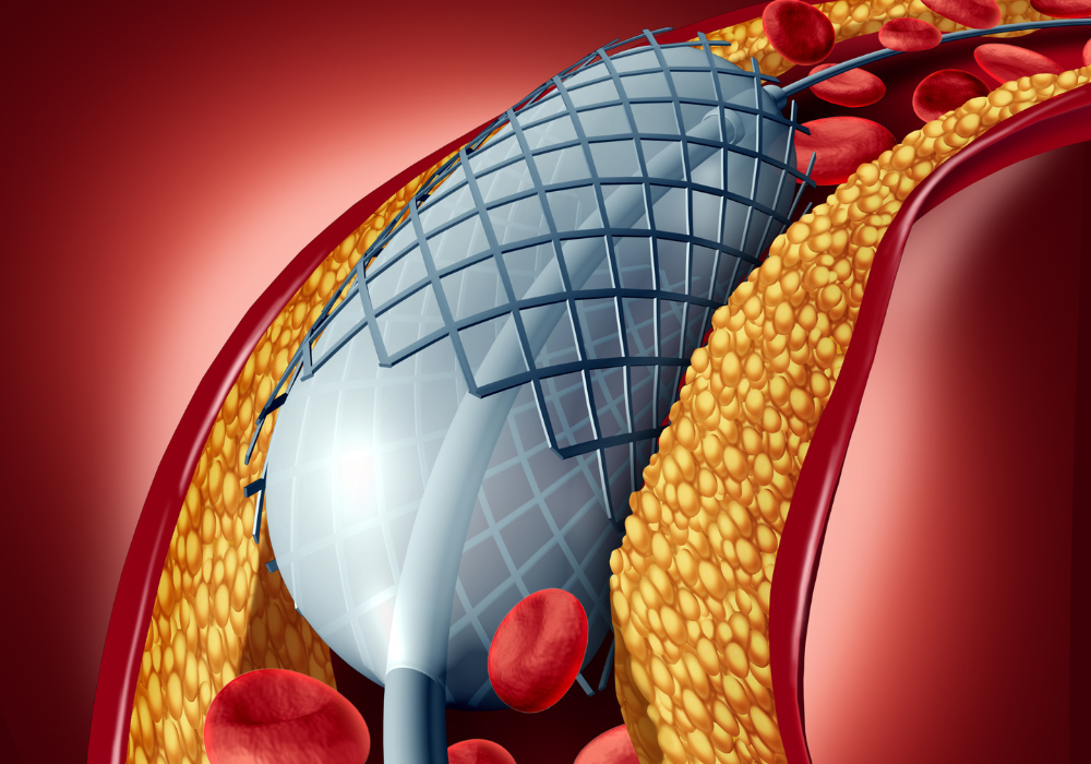 Stent Placement: Treatment for Peripheral Artery Disease