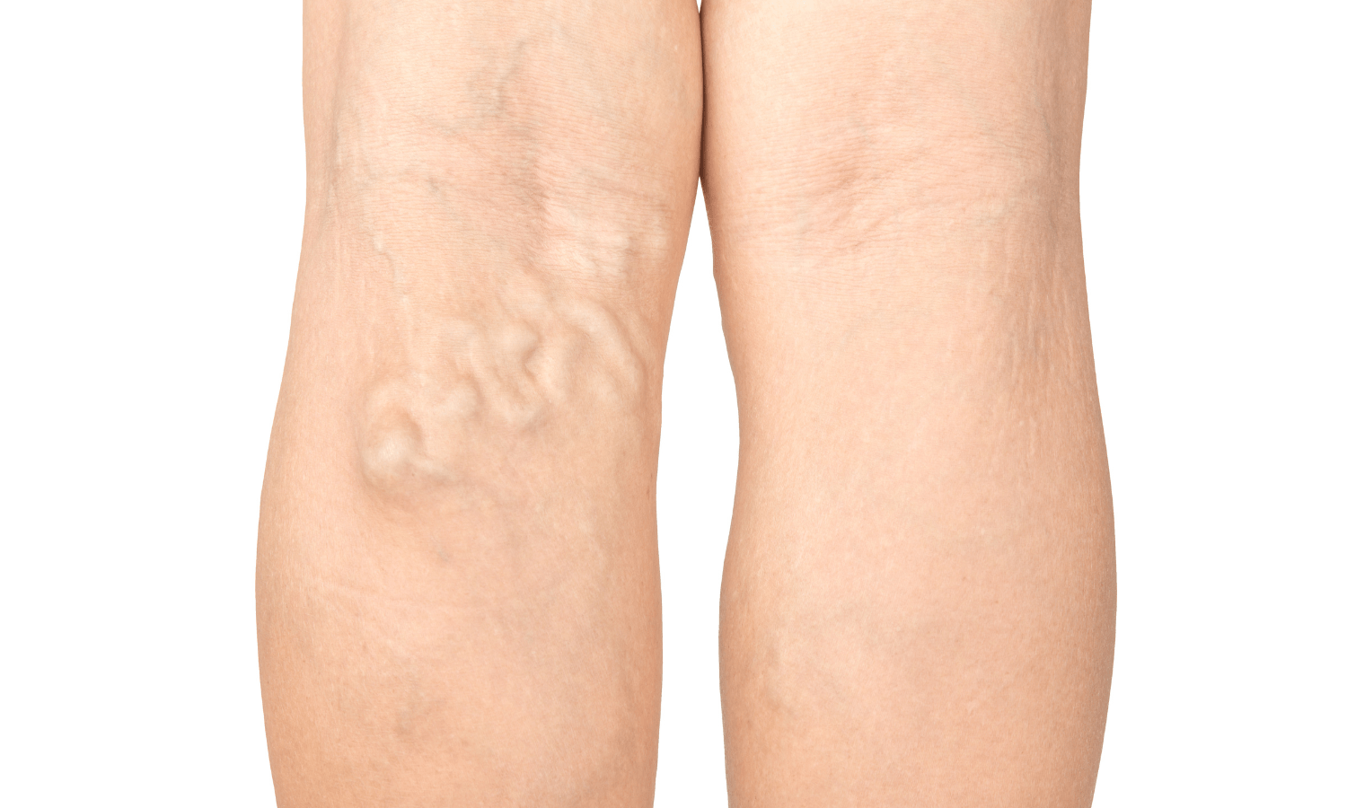 What Is The Success Rate Of Microphlebectomy?