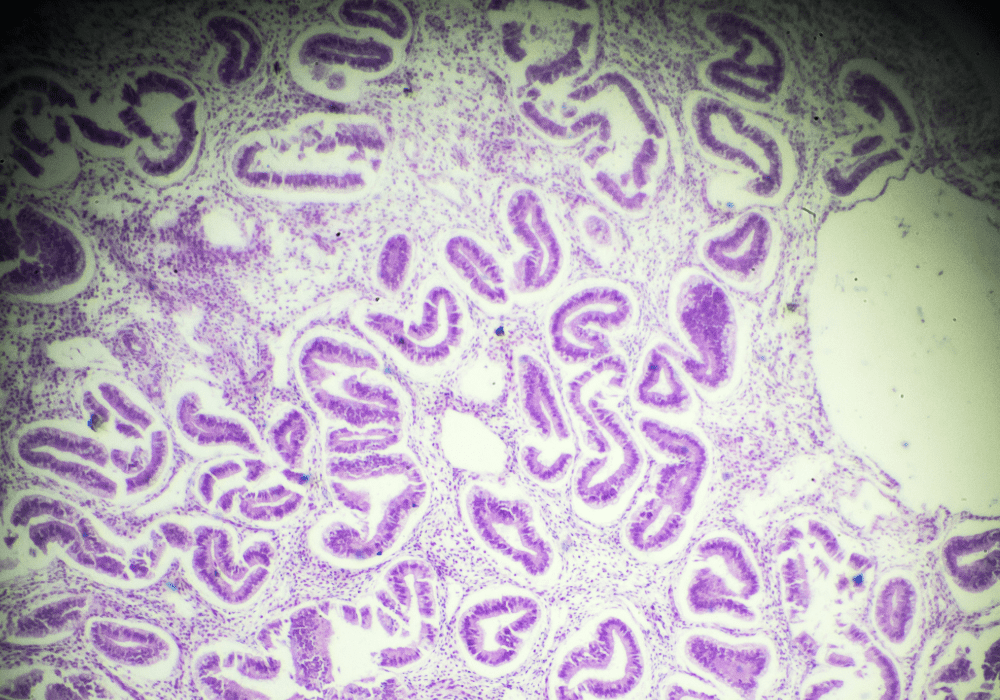 A close up of a purple and white Adenomyosis cell.