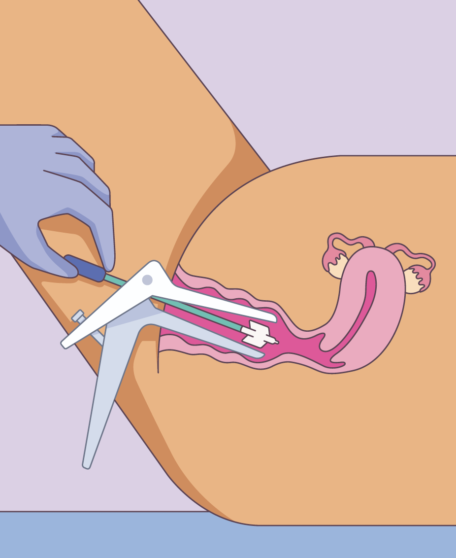 Image showing a speculum inserted into a vagina for the purpose of viewing and taking a sample from the cervix