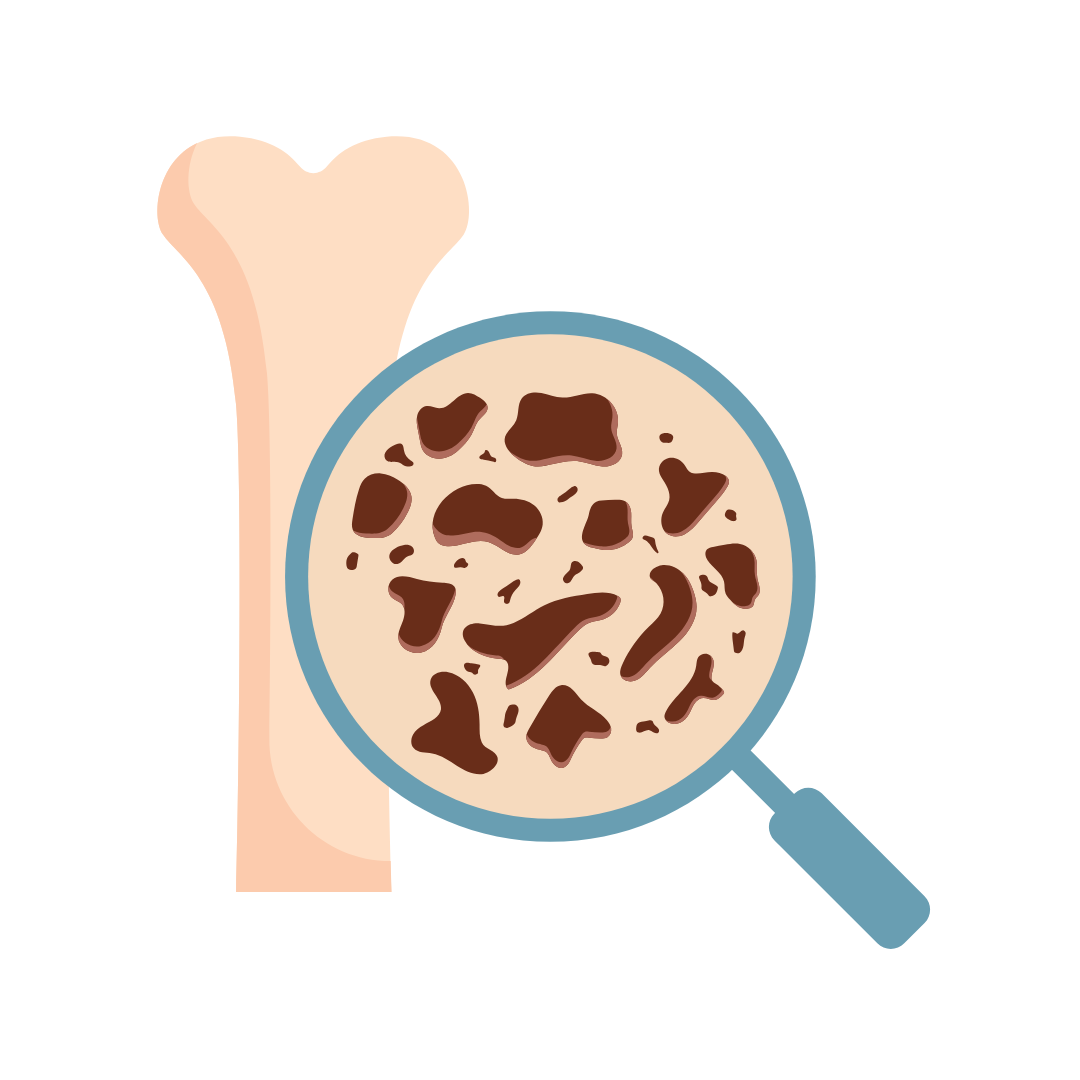 OSTEOPOROSI