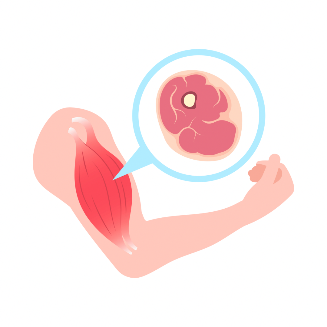SARCOPENIA