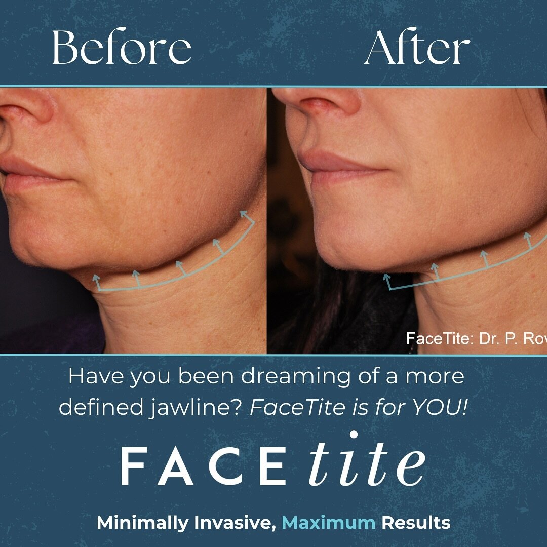 We LOVE a good FaceTite transformation 🤍 learn more about this minimally invasive service that provides maximum results 🪩

#facetiteresults #facetite&trade;️ #inmodeaesthetics #inmode #transformation #medspa #fortcollins #smallbusiness