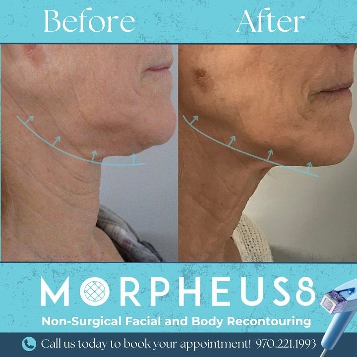 Looking for a snatched jawline this summer!? Say hello to Morpheus8! ⚡️🤍 

This Total Body Recontouring Treatment can treat wrinkles, acne scars, stretch marks, surgical scars and more!! Call us today to get your appointment booked! 🪩

#morpheus8 #