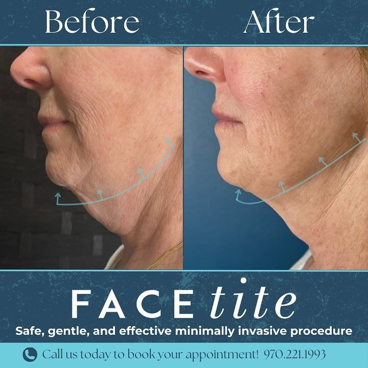 Check out this amazing FaceTite transformation!! ✨

Don&rsquo;t wait to get your FaceTite appointment scheduled, give us a call today! 📞

#facetite #facetiteresults #facetite&trade;️ #facetitebeforeandafter #inmode #transformation #beforeandafter #m