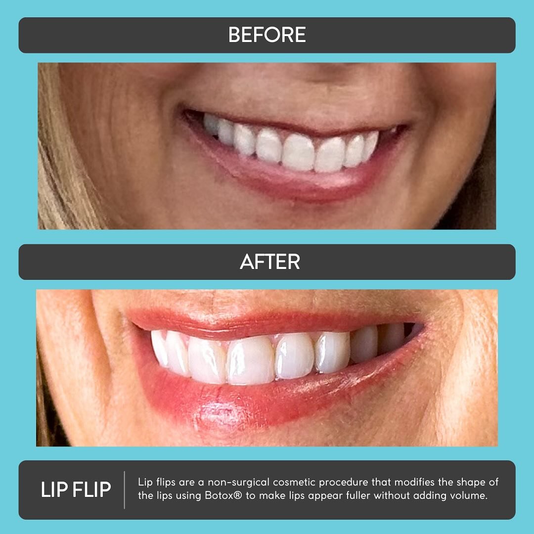 Looking for ways to plump your lips for the holidays? Book your lip flip appointment today!! 💋

#lipflip #lipflipbotox #botox #plumplips #medspa #fortcollins #milestoneaesthetics
