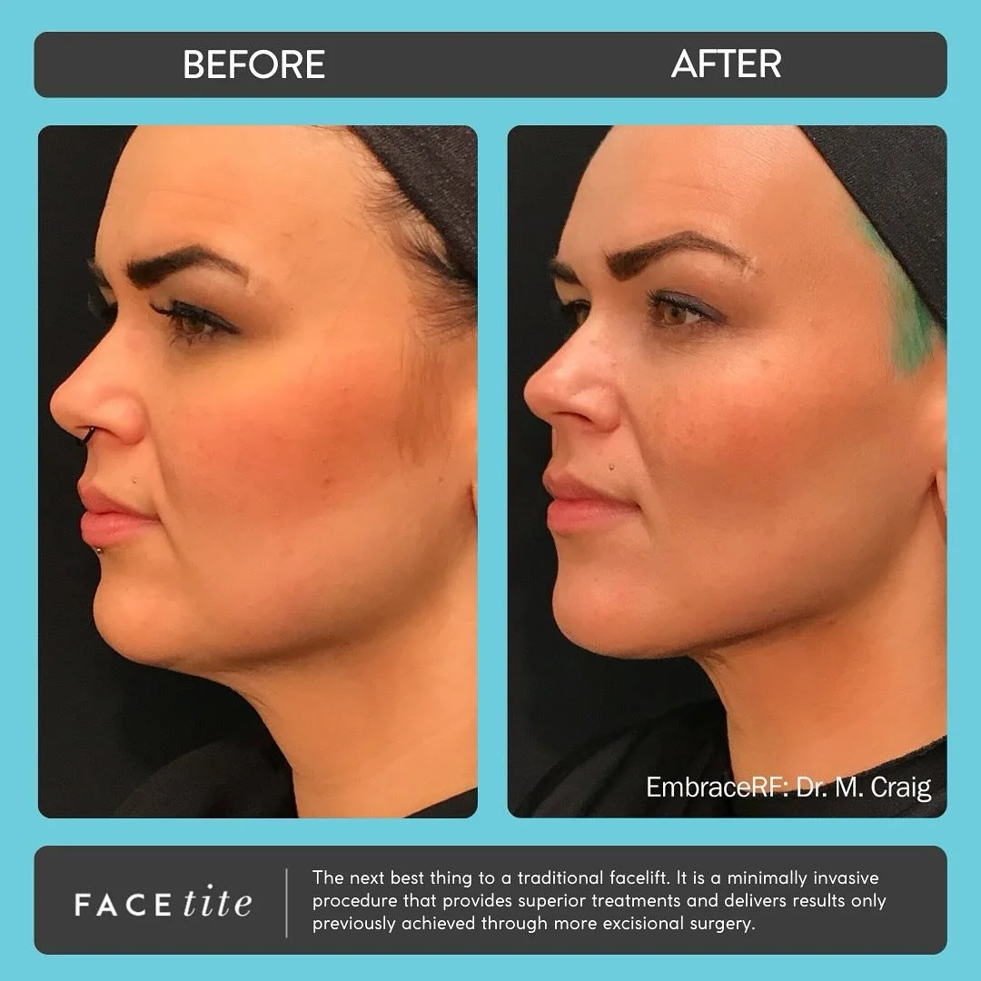 Love these results!? From now until the end of November get 20% OFF when you book your FaceTite appointment!! 📣 Turn back time this Black Friday!! ⏰
#facetite #facetitedeal #facetiteresults #transformation #blackfriday #deals #milestoneaesthetics #