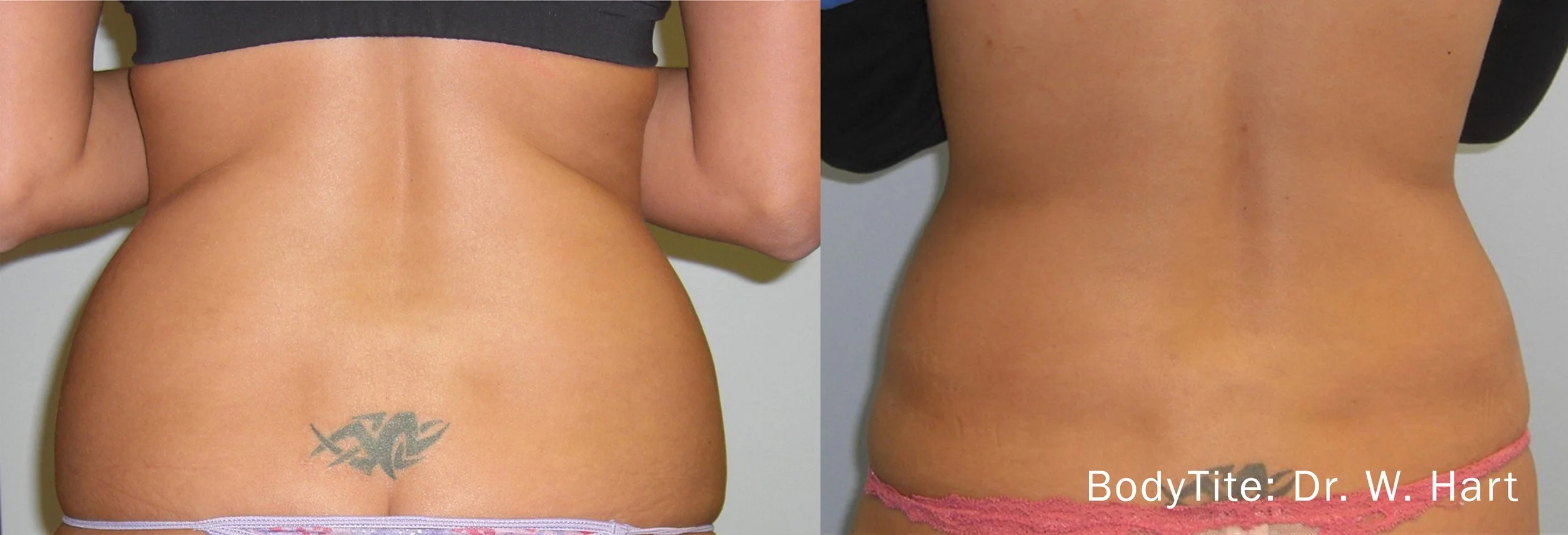 BodyTite Before and After Image of back fat reduction