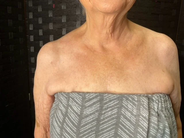 Close-up of an elderly woman with multiple age spots on her shoulders and chest, wrapped in a towel.