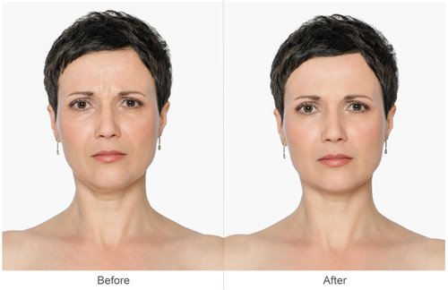 laser resurfacing 