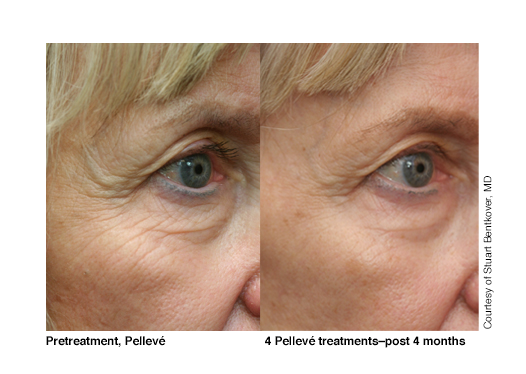 Eyes,+4+Pelleve+treatments,+post+4+months+(image+1).png