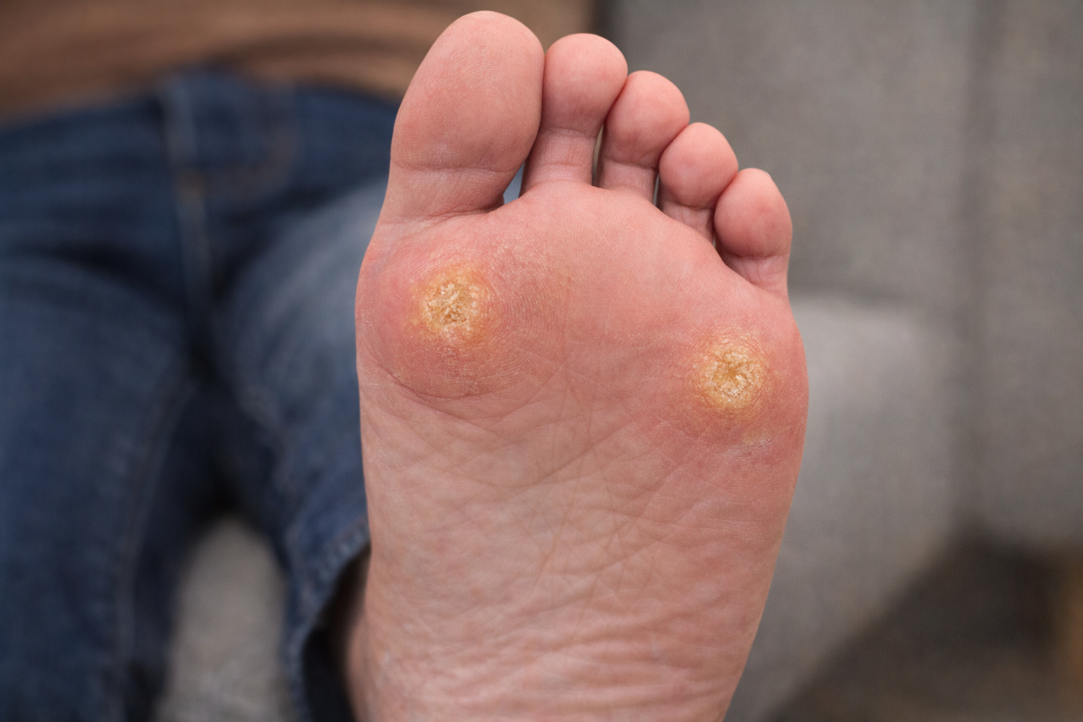 Plantar Callus Treatment Case Report: Managing Hyperkeratotic Foot Lesions in Katy &amp; Houston, TX