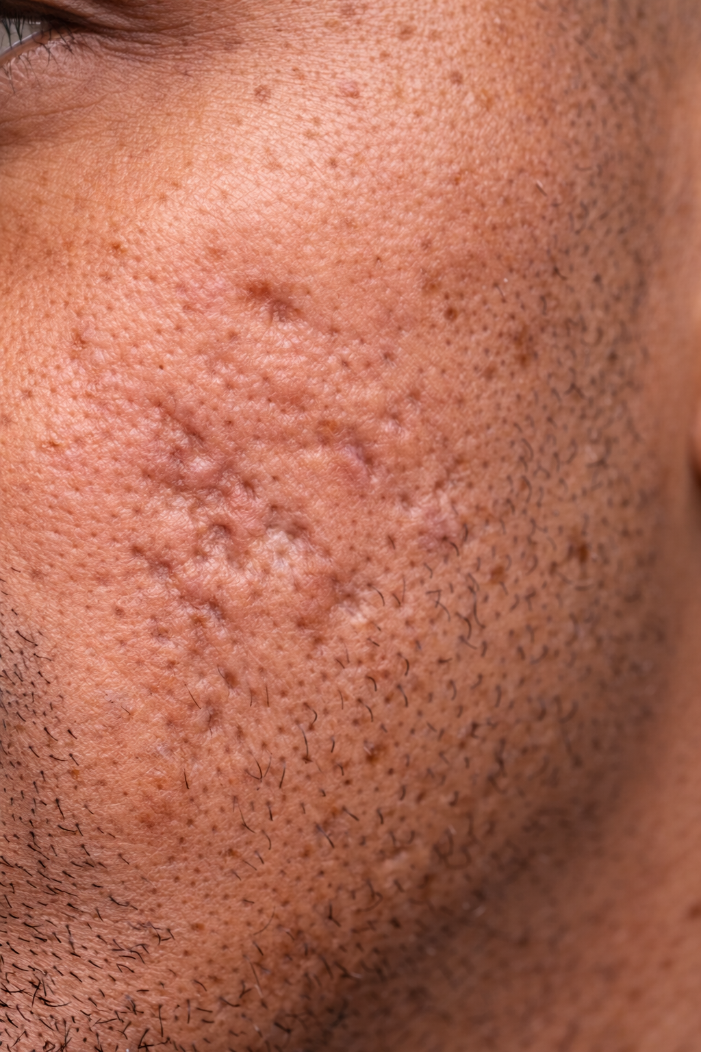 “Why Do I Still Have Acne Scars Years Later—and Can They Actually Be Fixed?”