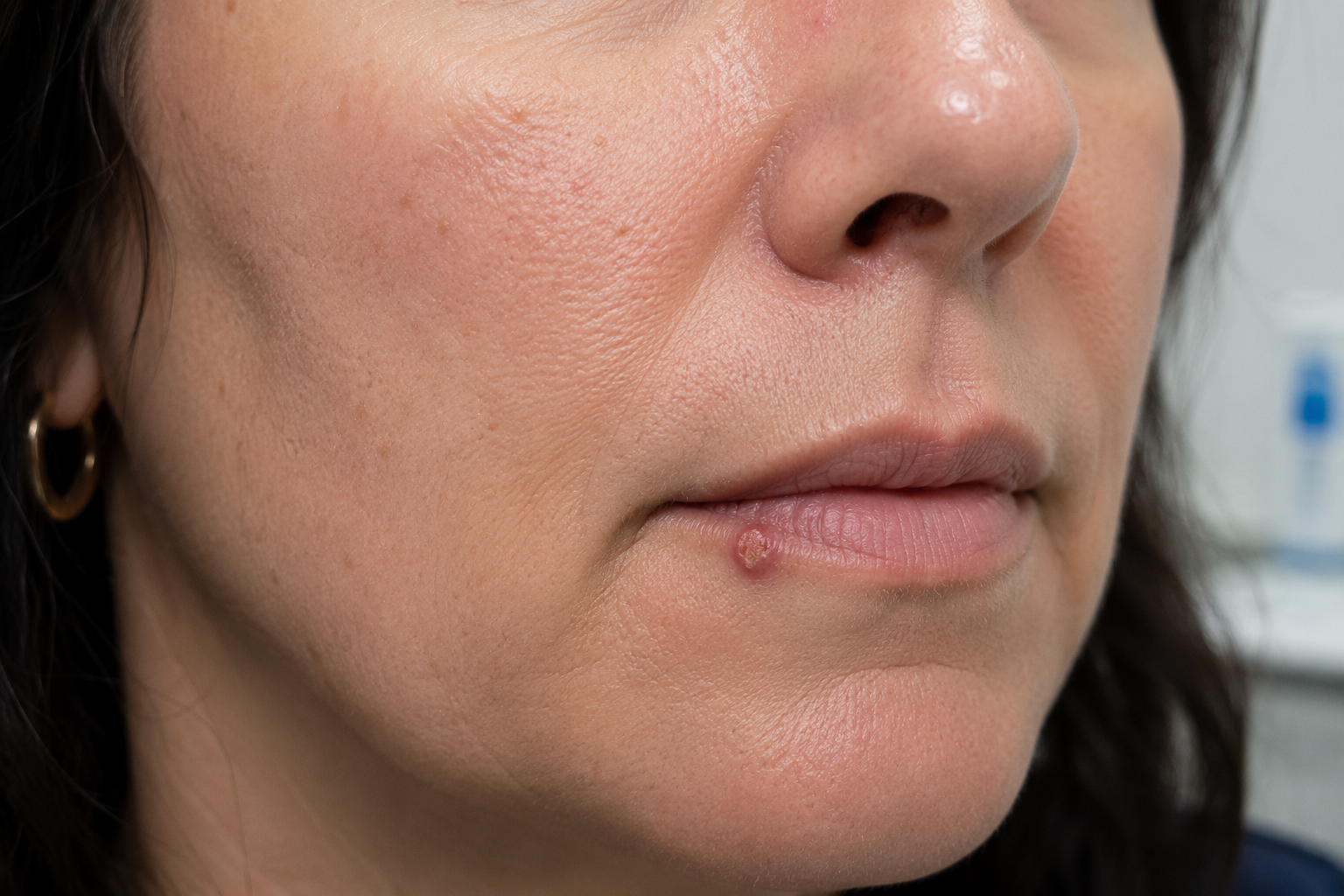 Wart on the Lip or Cold Sore? A Dermatologist Explains the Difference