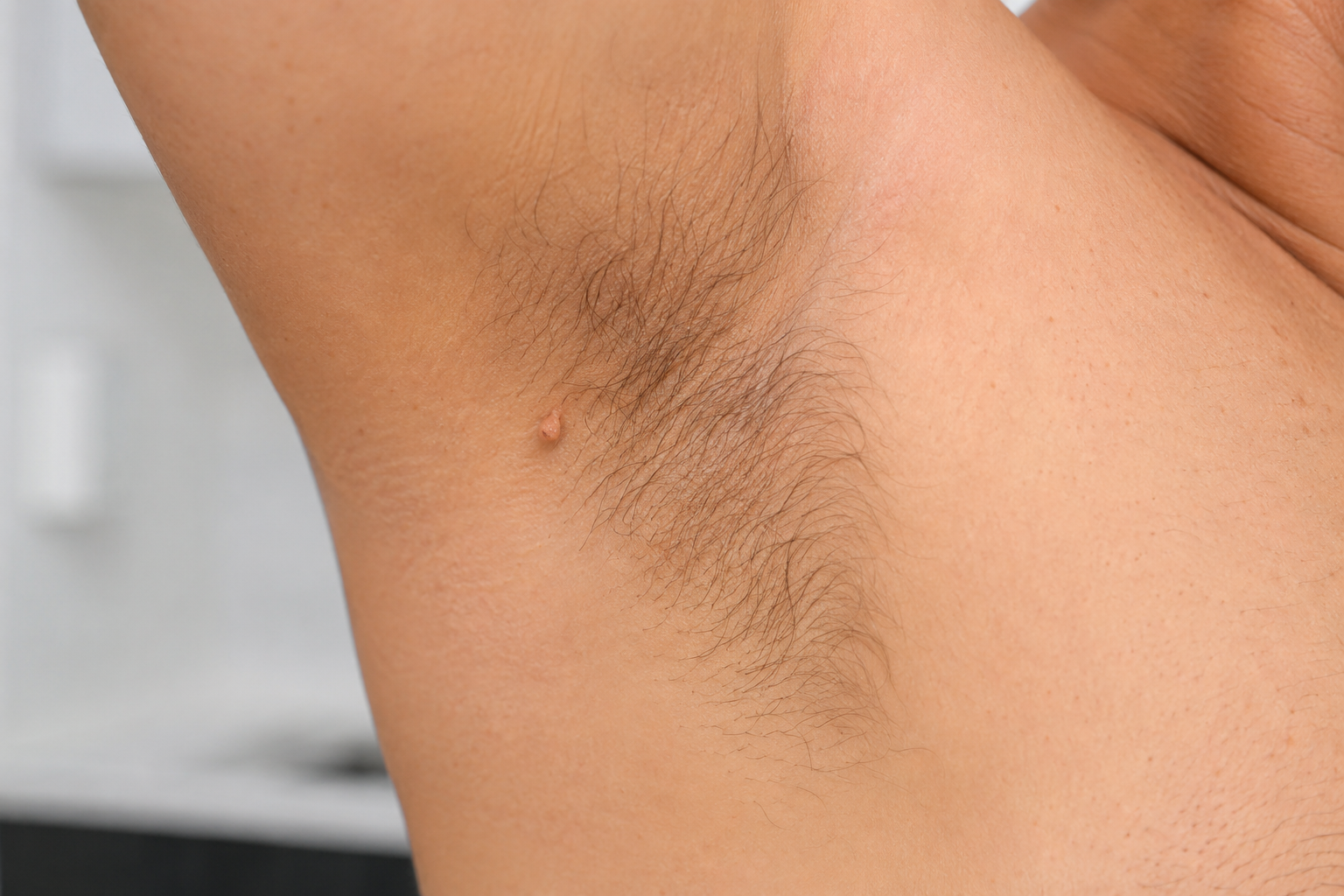 Irritated Skin Tag in the Armpit Successfully Removed: A Case Study from Village Dermatology