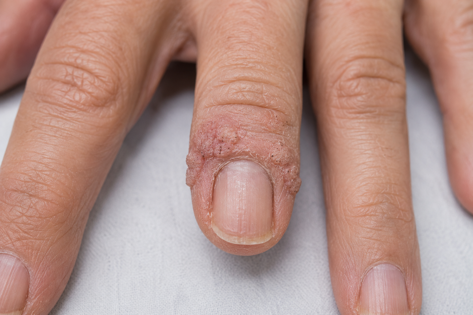 Why Do Periungual Warts Around the Fingernail Need Multiple Cryotherapy Treatments to Clear?