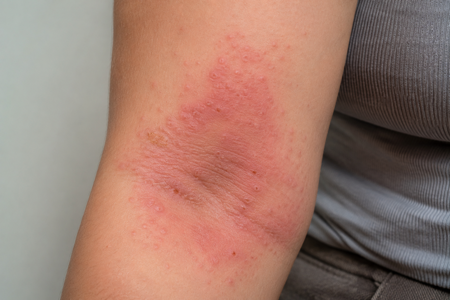 Why Am I Experiencing Penile Discomfort and Pain During a Lichen Planus Flare-Up?