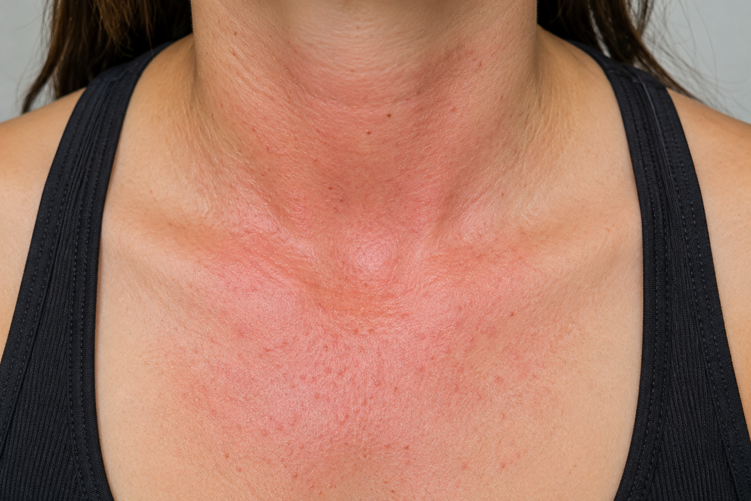 What Are My Options for Treating a Recurrent Nodular Basal Cell Carcinoma on My Cheek?