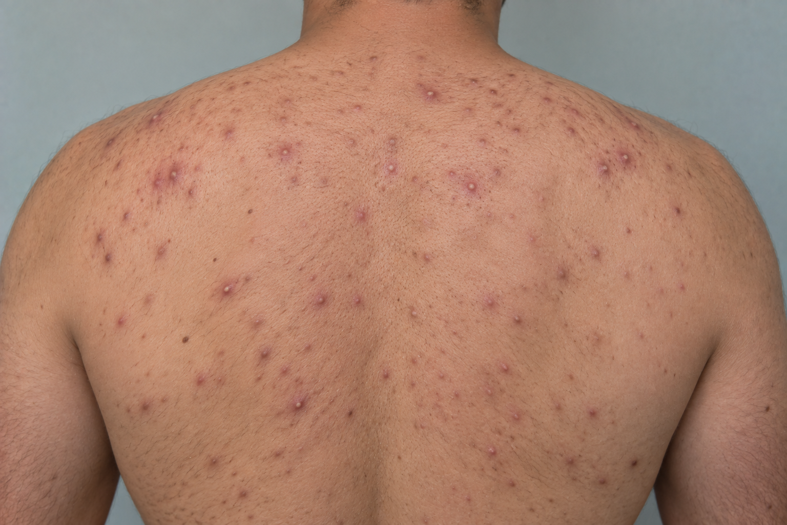 Why Is My Back Acne Not Clearing Up With Over-the-Counter Washes?