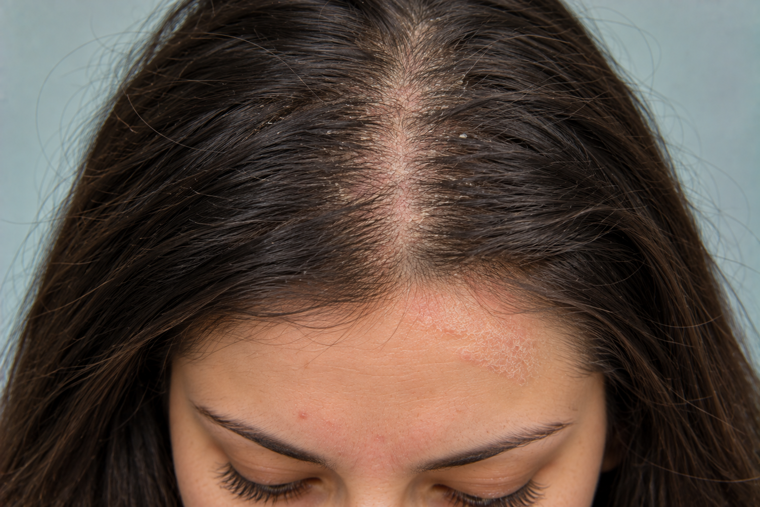 I Thought I Had Psoriasis—Could My Flaky, Itchy Scalp Actually Be Seborrheic Dermatitis?
