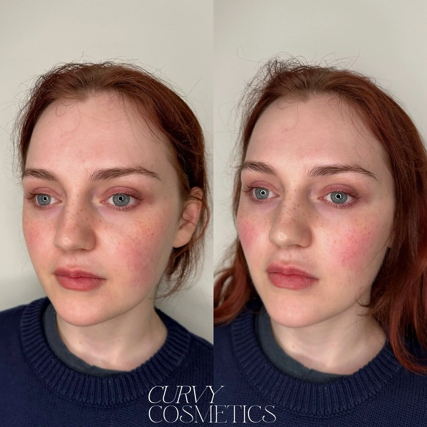 As we age, our collagen production slows down, the fat pads in our faces shift and our skin becomes lax. This natural aging process results in the emergence of deep facial grooves, as ligaments become more visible, leading to pronounced lines and a r