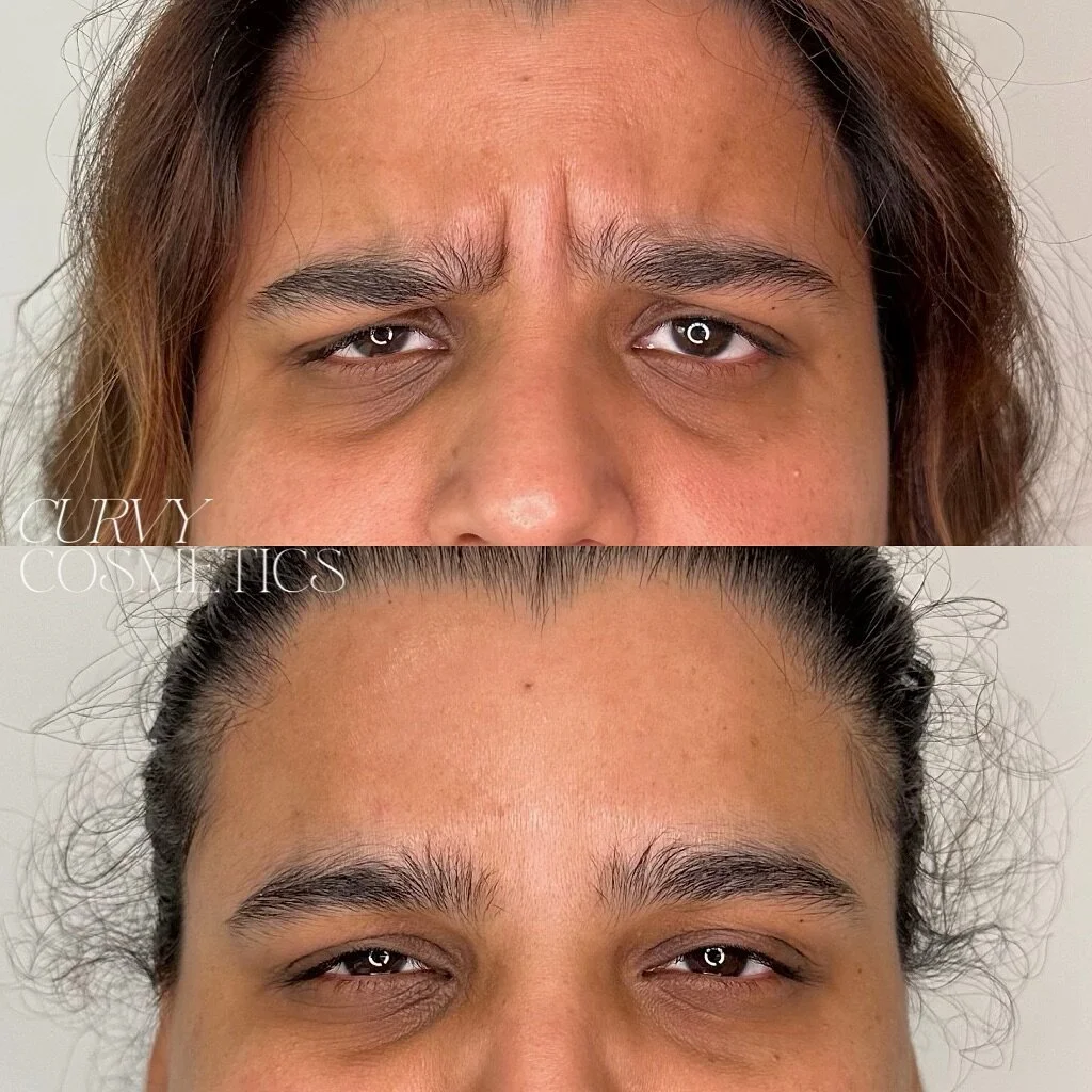 First time antiwrinkle for this patient, who&rsquo;s main goals were to reduce her frown lines. We think we nailed it! 

#antiwrinkle #antiwrinklemelbourne #cosmeticinjectablesmelbourne #melbournecosmeticnurse