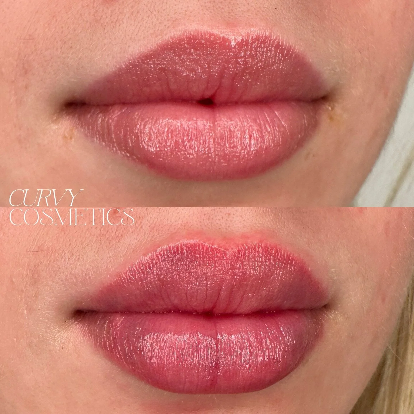 Starting the new year off right with these beautiful, hydrated lips! By using a small amount of dermal filler, we&rsquo;re able to enhance your lips, while still respecting the their natural anatomy. 

#lipfiller #lipfillersmelbourne #dermalfillersme