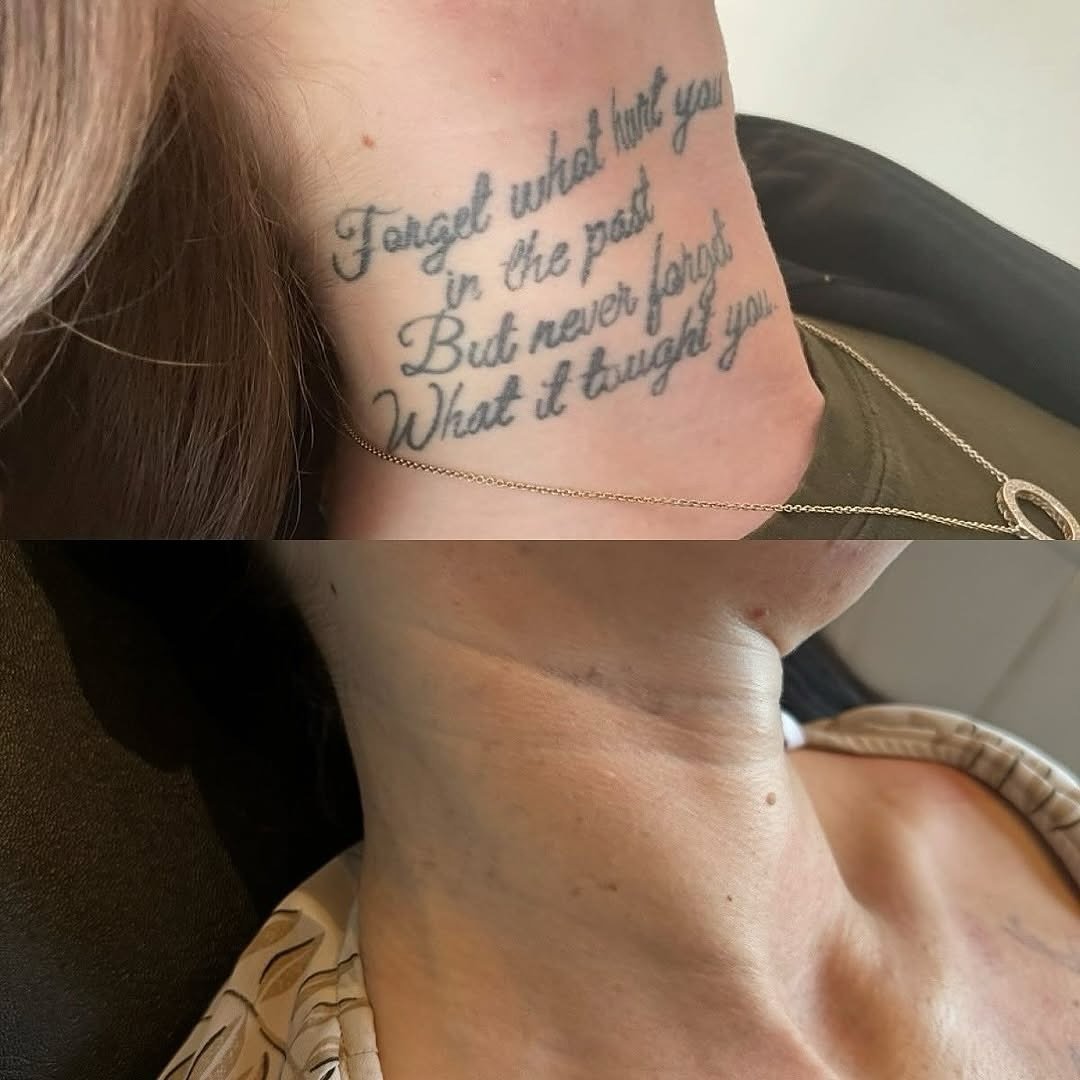 Tatueringsborttagning med PicoPlus hos NUDE! 💥

Klar! - Samantha fick idag sin sj&auml;tte och sista behandling av sin tatuering p&aring; halsen. Vi har som utg&aring;ngspunkt haft 6&ndash;8 veckor mellan varje behandling f&ouml;r att n&aring; resul