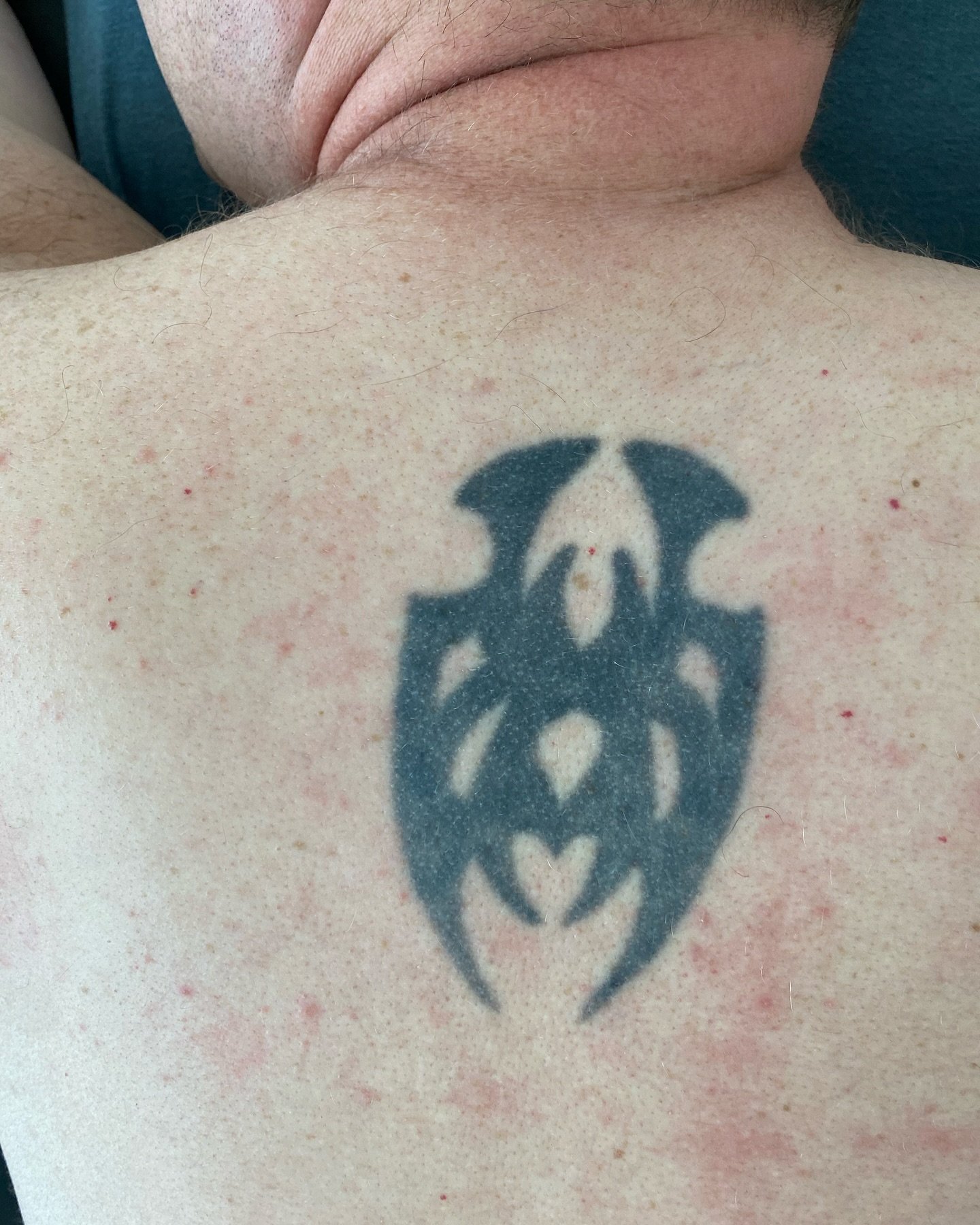 Tatueringsborttagning med PicoPlus hos NUDE! 💥

Klart! - Joakim har totalt f&aring;tt 10 behandlingar f&ouml;r sin tatuering p&aring; ryggen. Idag gav vi honom den sista behandlingen f&ouml;r att n&aring; hela v&auml;gen i m&aring;l. 

De sista pigm
