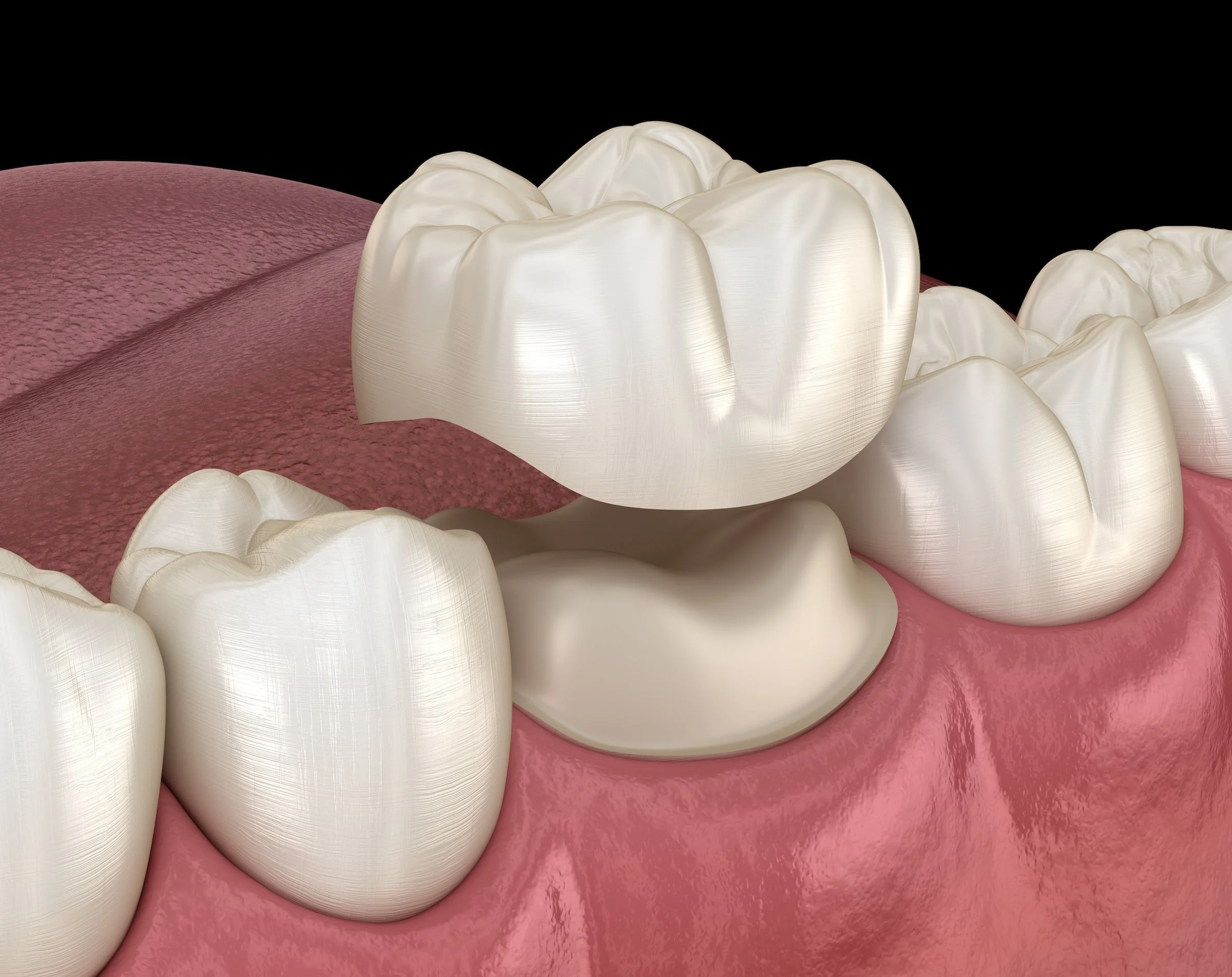 Dental crown