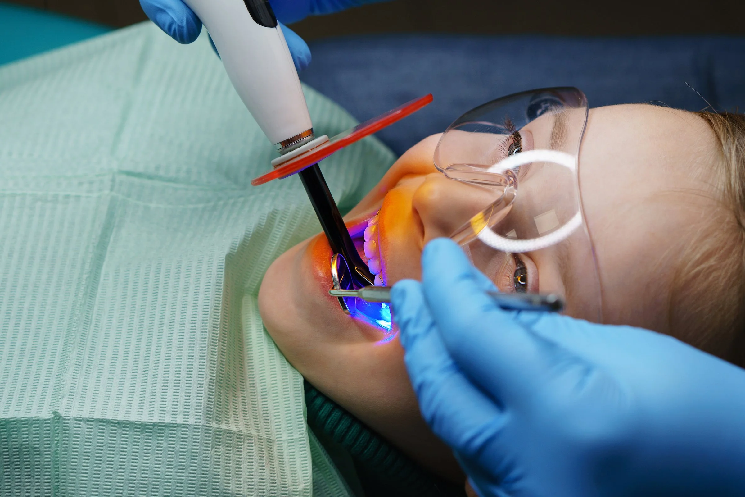 Sealants on teeth