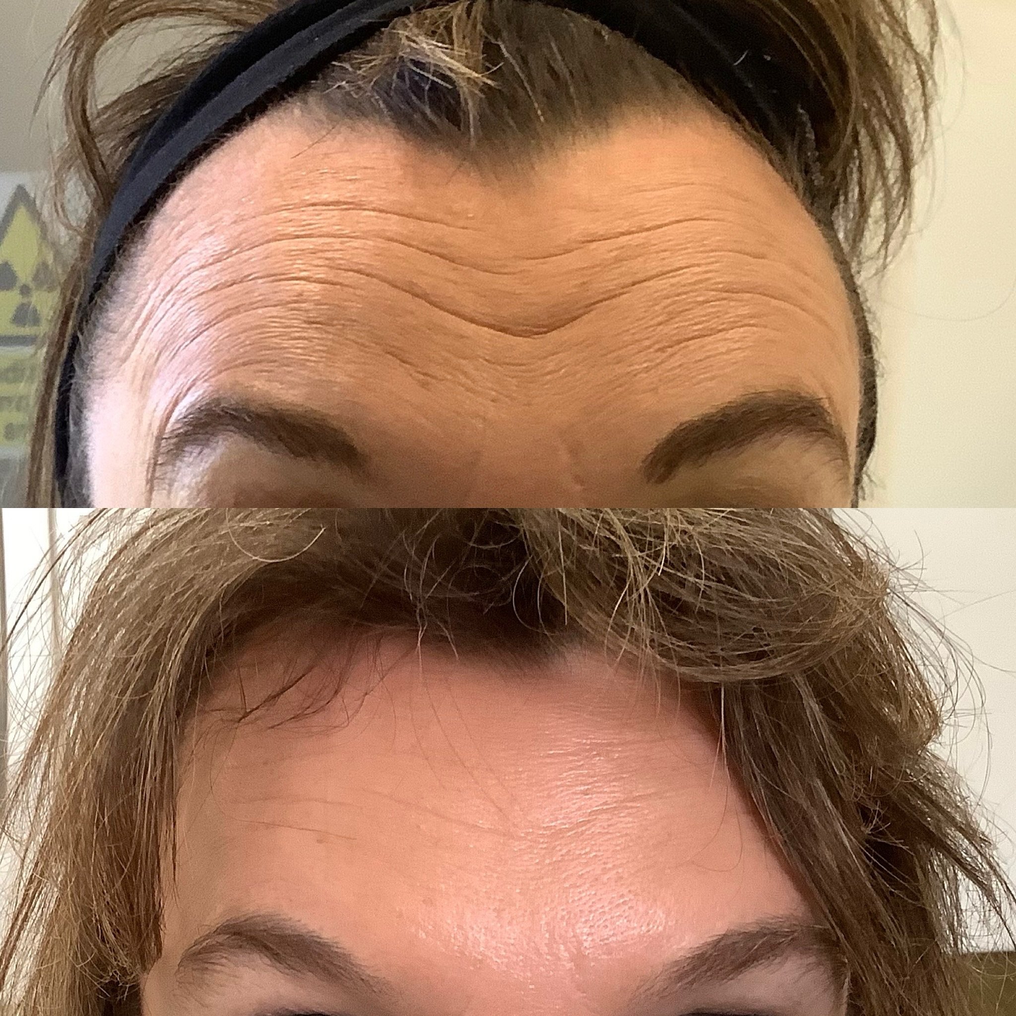 An example of how good Botox maintains movement whilst reducing lines! 

Top: Before Botox, shows lines when prompted to raise eyebrows
Below: 3 weeks after Botox administration, shows much reduced lines even when raising eyebrows highlighting natura