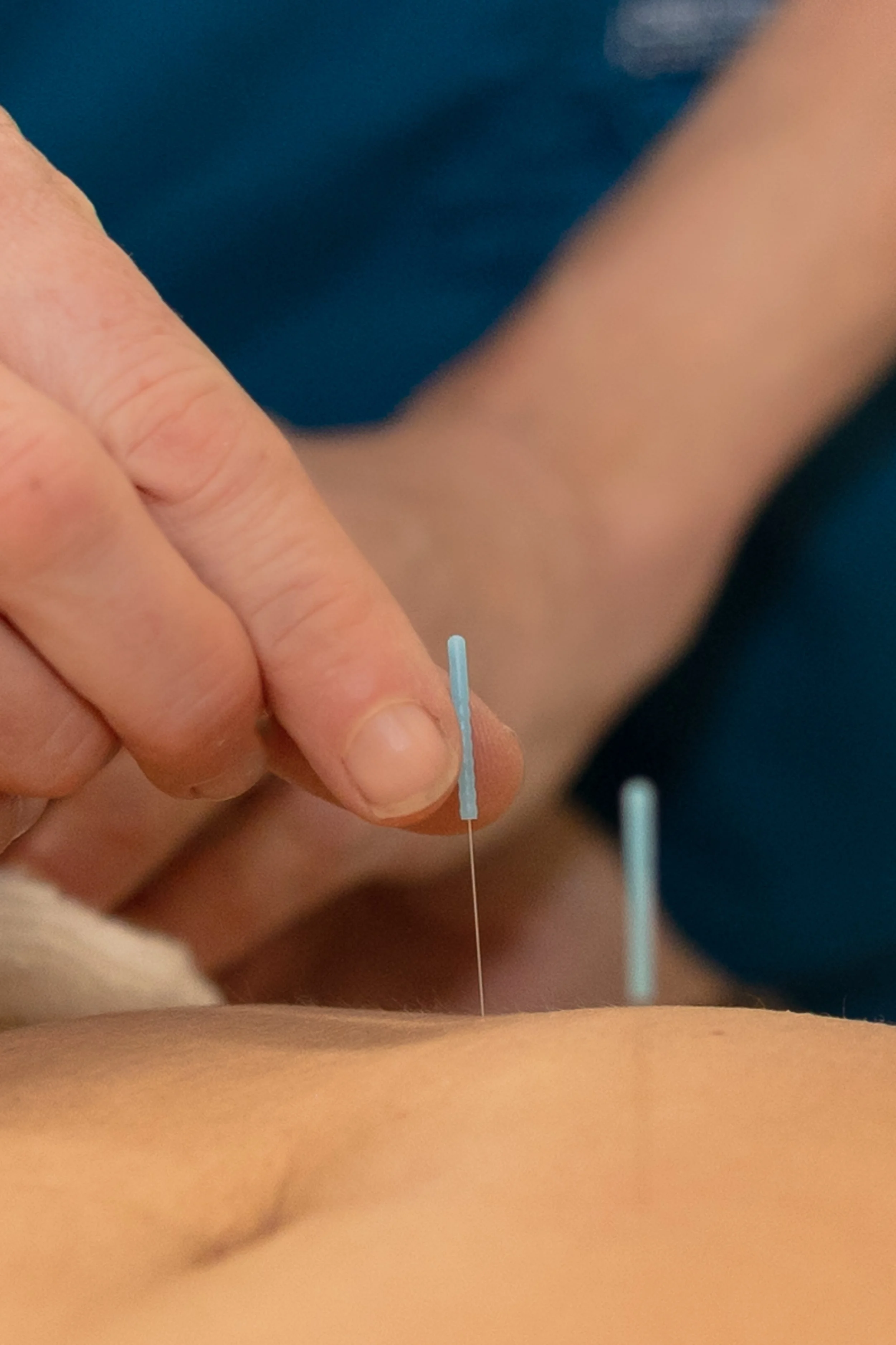 acunpunture-health-doctor-needles-san-diego.jpg