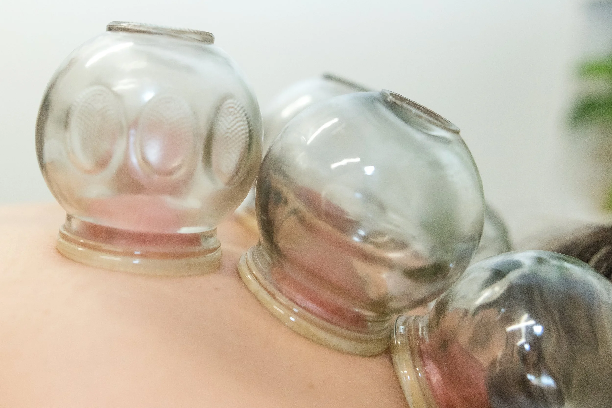 cupping-practitioner-health.jpg