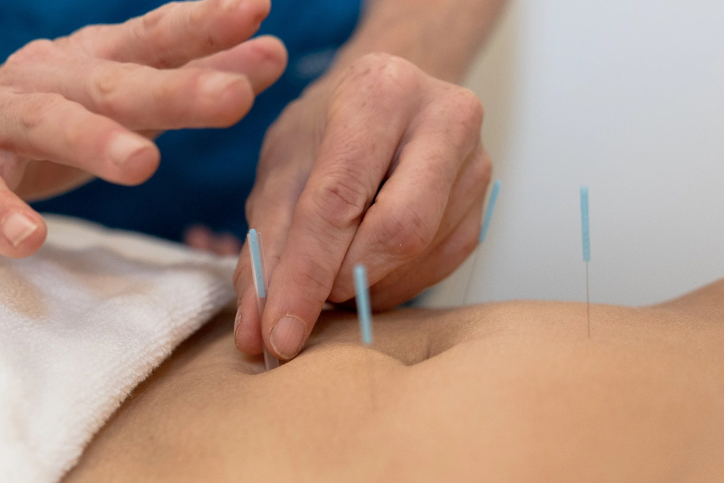 acupuncture-needles-clinic.jpg