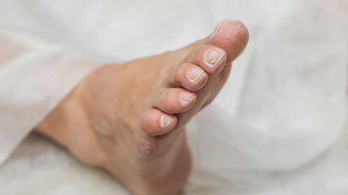 What Does a Diabetic Foot Ulcer Look Like?